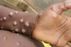 La variole du singe, déclarée urgence continentale en Afrique