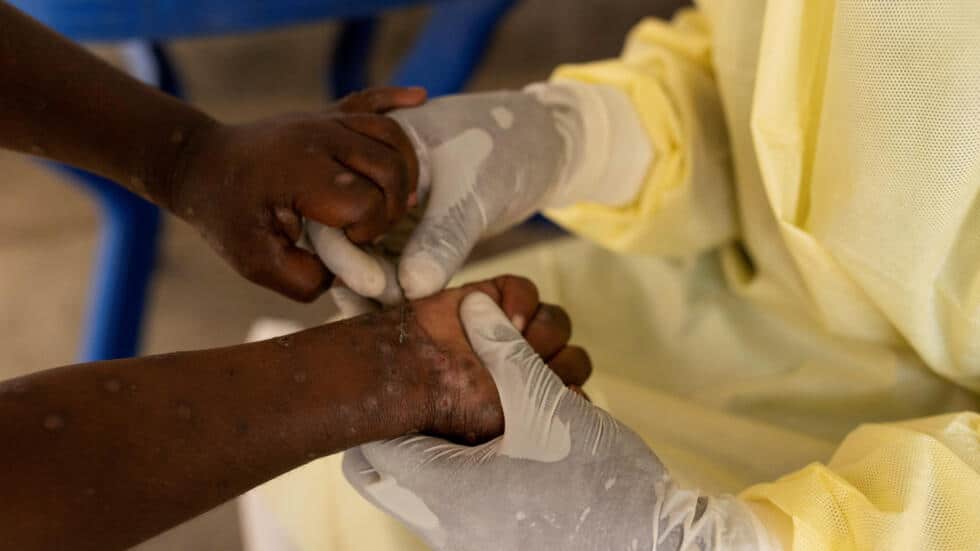 Mpox : « la RDC a besoin de 3.500.000 doses de vaccins pour stopper sa propagation »